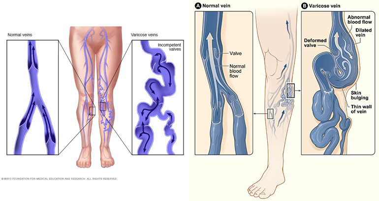 靜脈曲張因侵犯到腿部靜脈的部位及嚴重程度不同，在外觀上可以藍綠色明顯的網狀靜脈、藍紫色毛細血管擴張或鼓脹彎曲突起的靜脈瘤類型表現。
