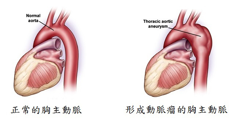 正常的胸主動脈與形成動脈瘤的胸主動脈