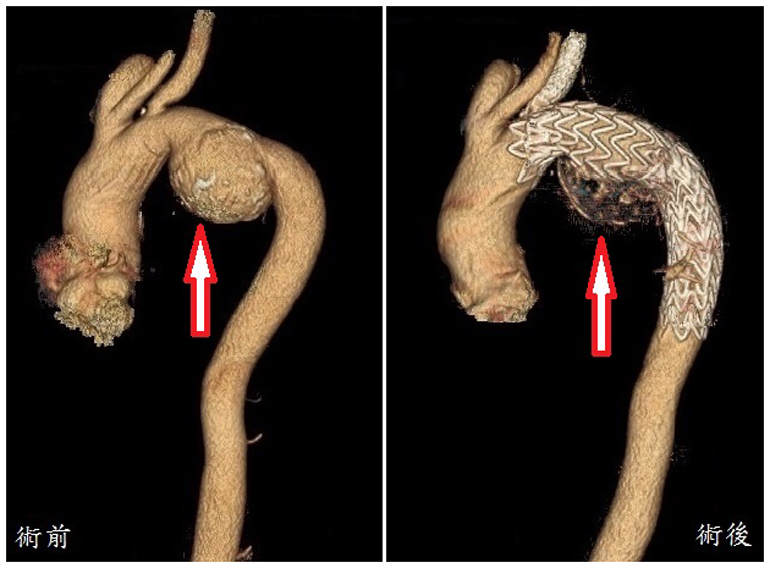 位於主動脈弓及降主動脈小彎交界處的主動脈瘤，以大支架及第三分枝血管的小支架治療。